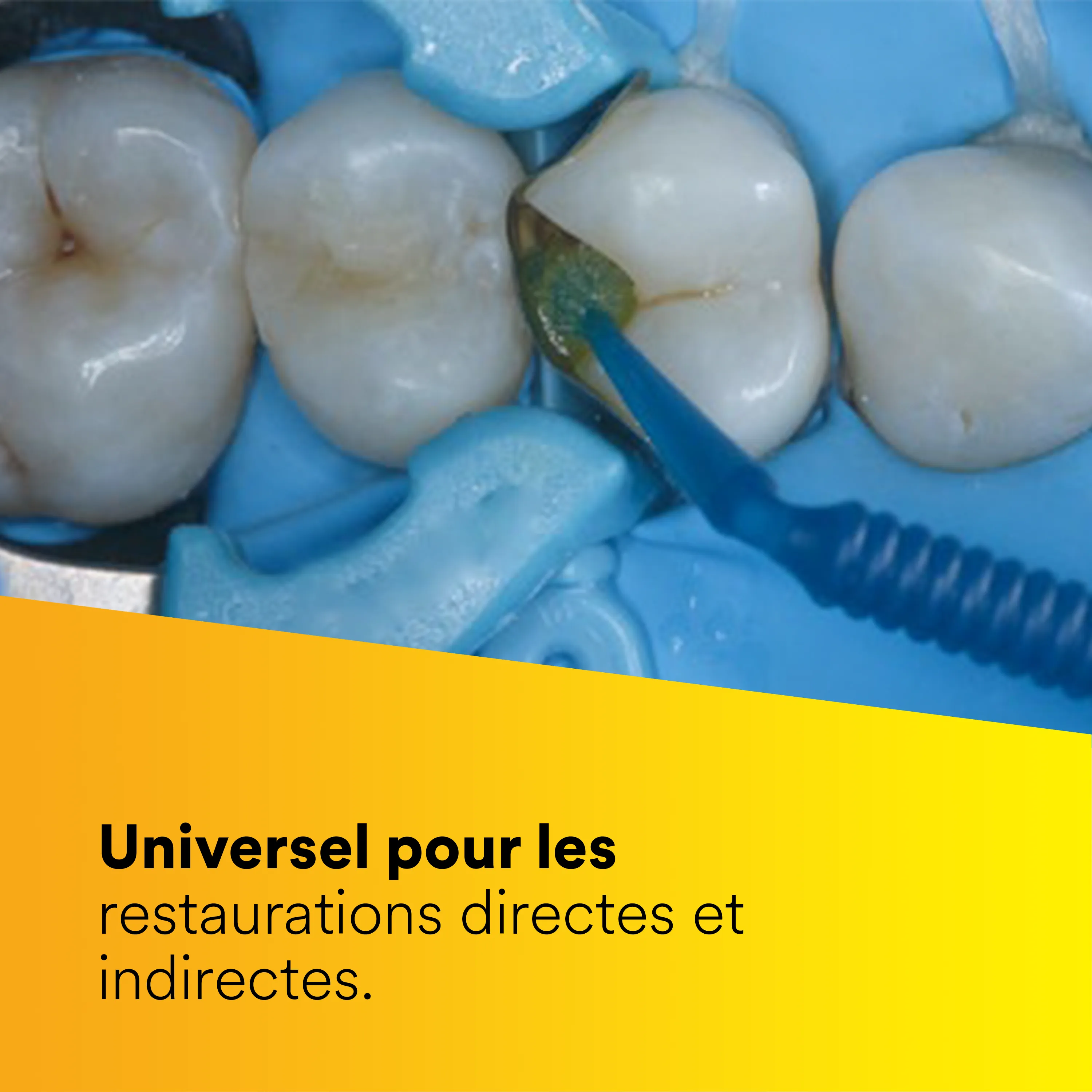 3M™ Scotchbond™ Universal Plus Adhésif, boîte d'introduction avec 50 L-Pop